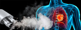 Fumées d'échappement diesel face à un poumon atteint d'une tumeur, par SANUSq Health sur le diesel et le cancer