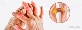 Mains douloureuses avec articulations enflammées et schéma d'une crise de goutte — SANUSq Health