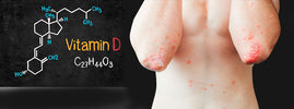 Coudes atteints de psoriasis et structure chimique de la vitamine D — SANUSq Health
