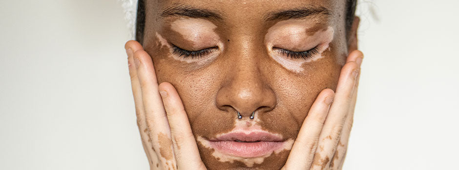 Femme atteinte de vitiligo, les yeux fermés et le visage entre les mains, taches dépigmentées autour des yeux et des lèvres, SANUSq Health